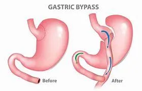 Gastric bypass